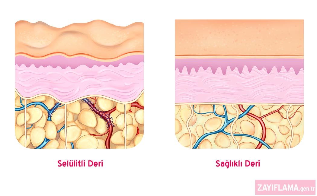 Selülit Nedir? Öncelikle selülit bir hastalık değil kozmetik bir sorundur.