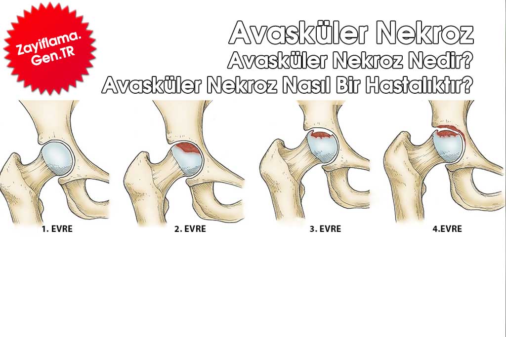 Avasküler Nekroz