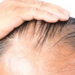 Saç Dökülmesi Nedenleri ve Saç Dökülmesini Durdurmanın Yolları Nelerdir ?
