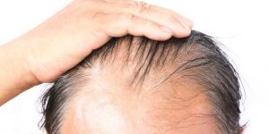 Saç Dökülmesi Nedenleri ve Saç Dökülmesini Durdurmanın Yolları Nelerdir ?