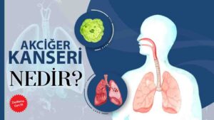 Akciğer Kanseri Nedir?