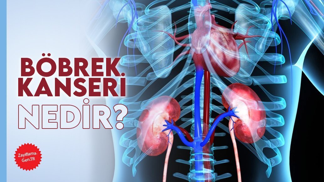 Böbrek Kanseri Nedir?