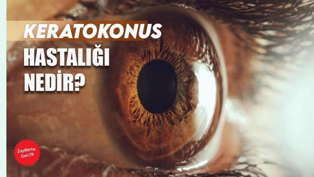 Keratokonus Hastalığı Nedir Belirti Ve Tedavi Yöntemleri Nelerdir?