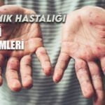 Kızamık Nedir Belirti ve Tedavi Yöntemleri Nelerdir?