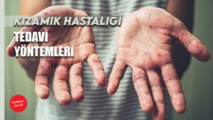 Kızamık Nedir Belirti ve Tedavi Yöntemleri Nelerdir?