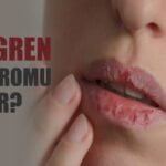 Sjogren Sendromu Nedir?