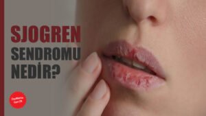 Sjogren Sendromu Nedir?