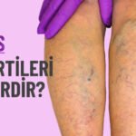 Varis Nedir Belirti ve Tedavi Yöntemleri Nelerdir?