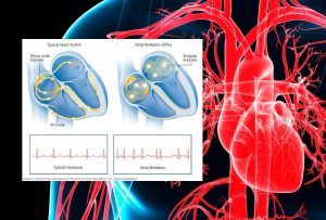 Atriyal Fibrilasyon (A-fib): Nedenleri, Belirtileri ve Tedavi Seçenekleri